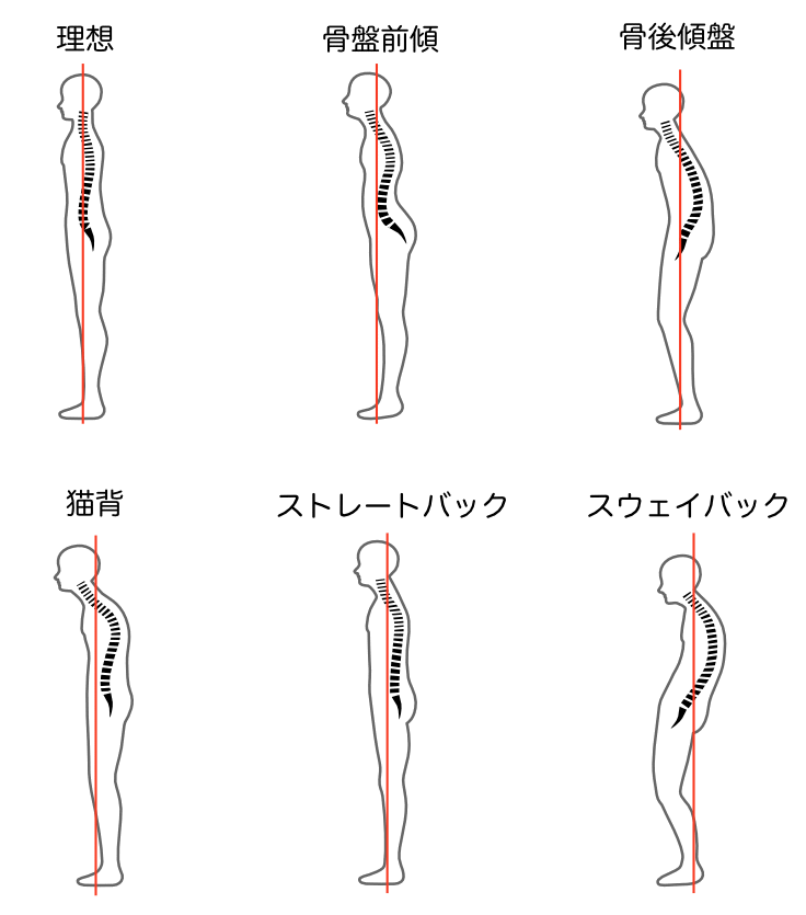 ストレートバック,骨盤前傾,骨盤後傾,猫背,スウェイバック