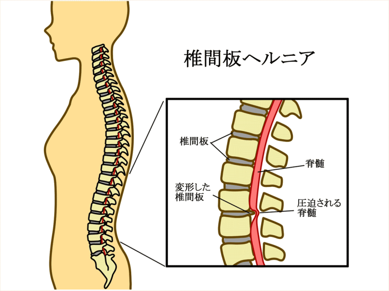 椎間板ヘルニア,腰痛