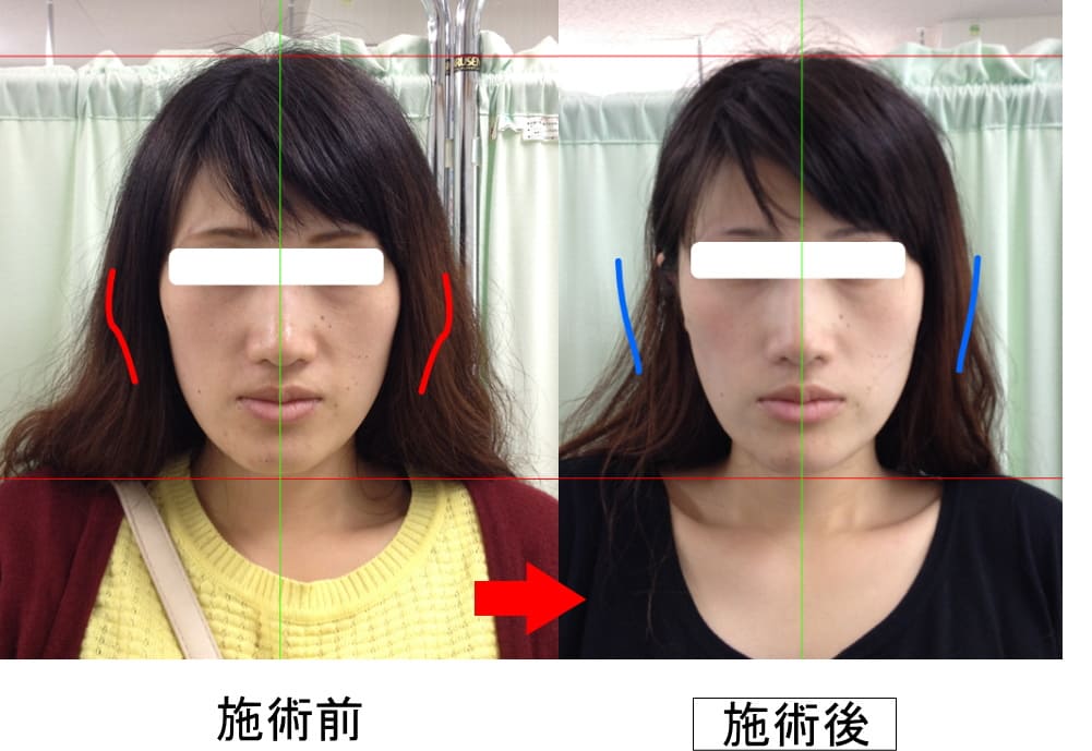 大崎市 小顔矯正ビフォーアフター