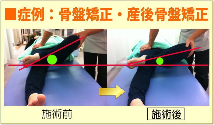 骨盤矯正
